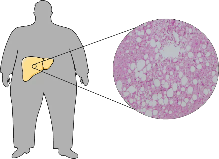 Illustration of nonalcoholic fatty liver disease.